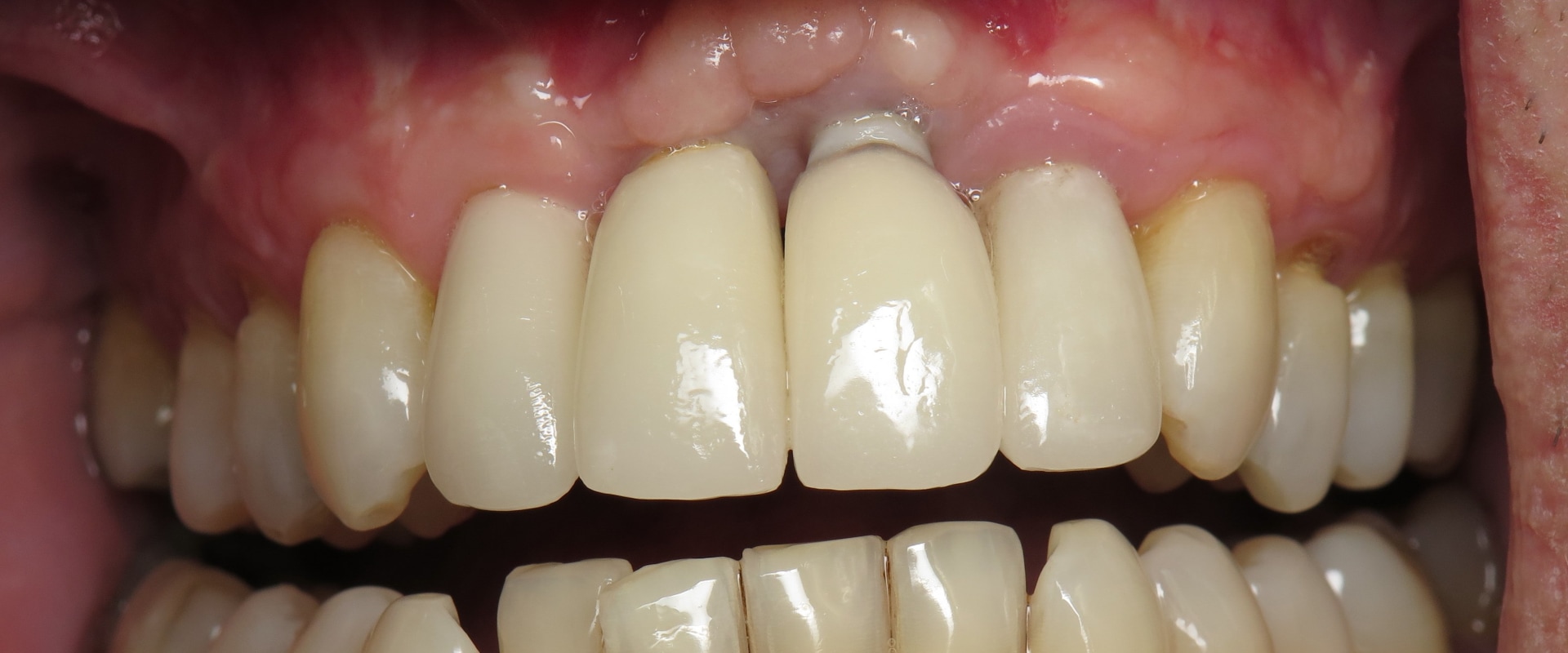 When dental implants don't work?