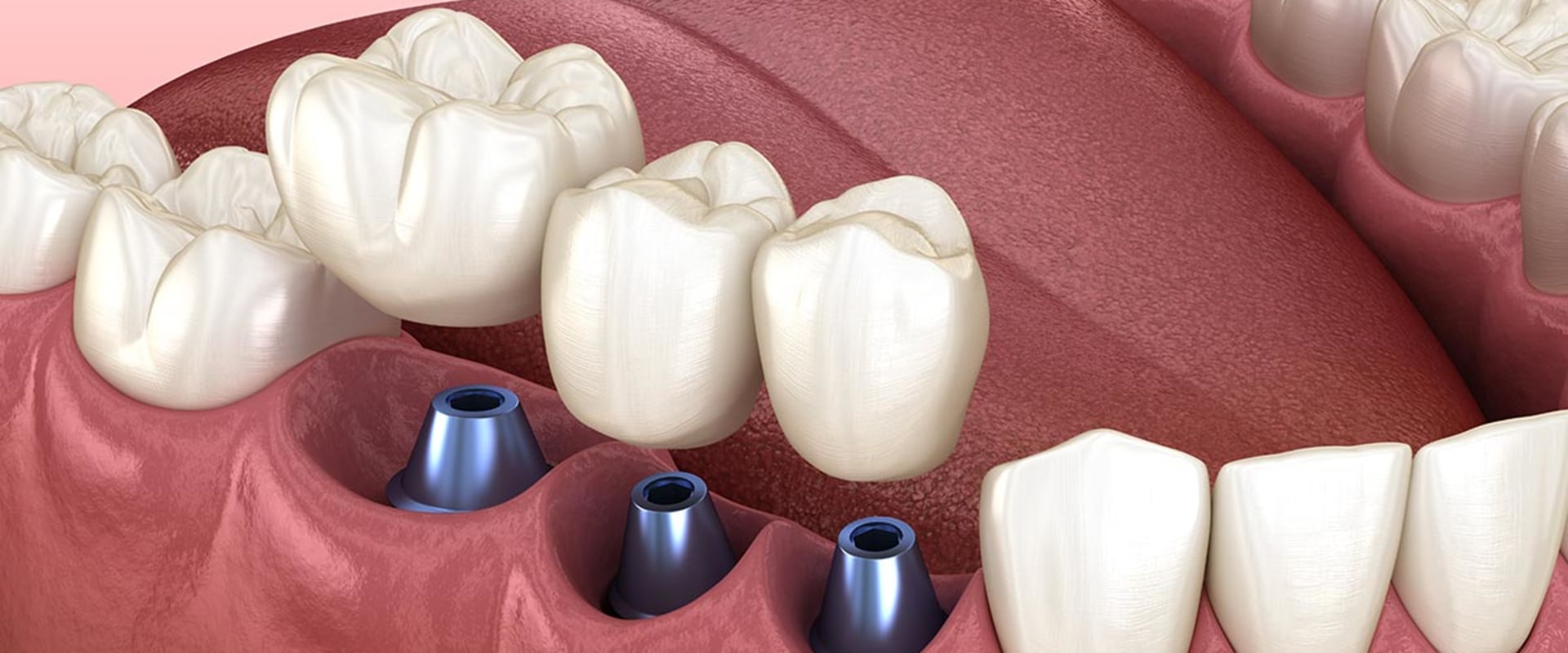 Are teeth implants worth it?