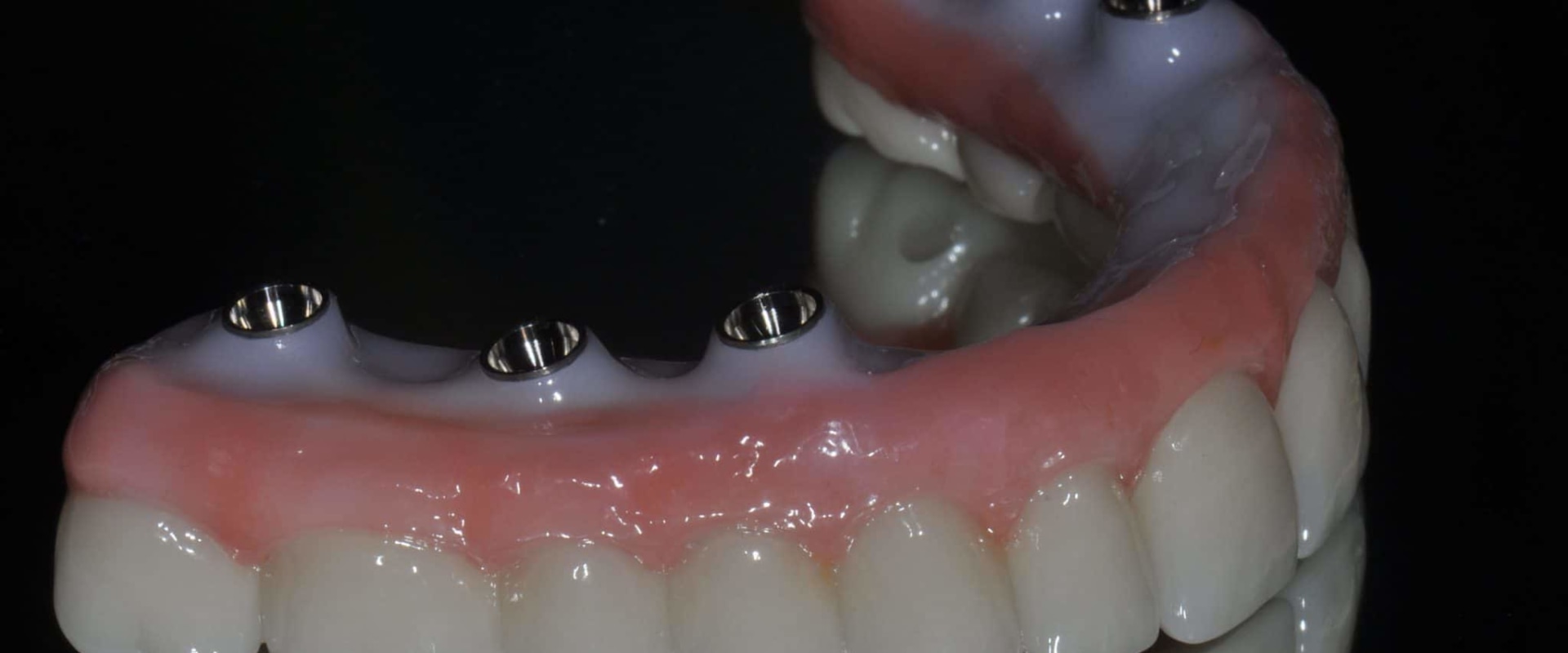 What are the best teeth implants made of?