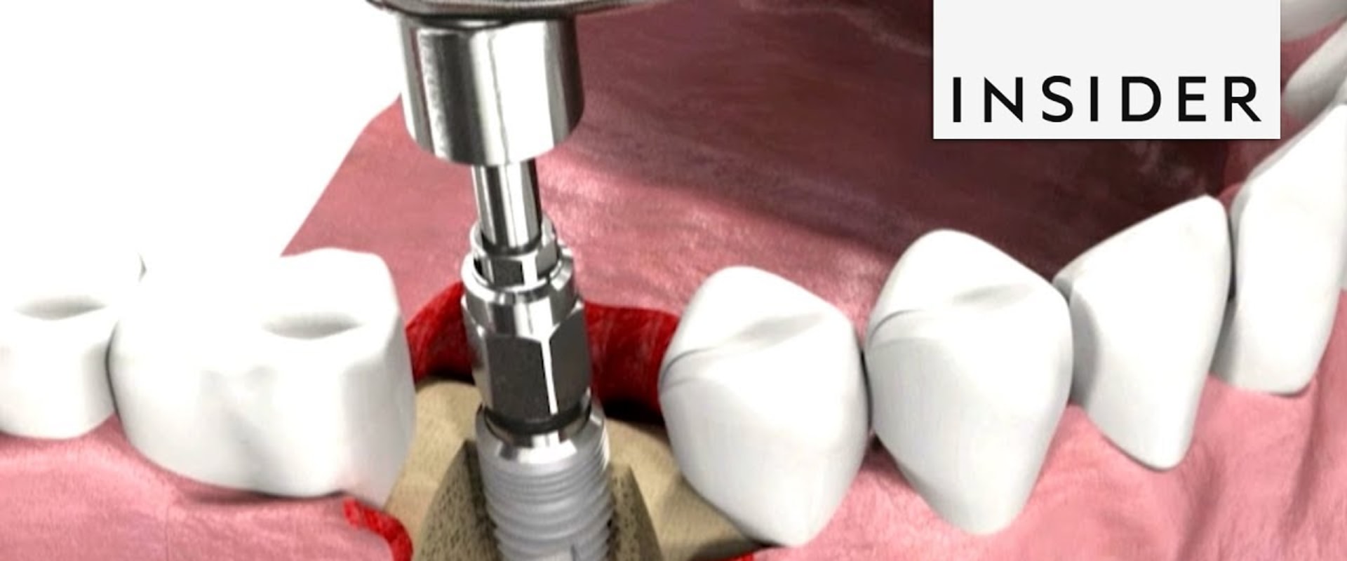 How dental implants are put in?