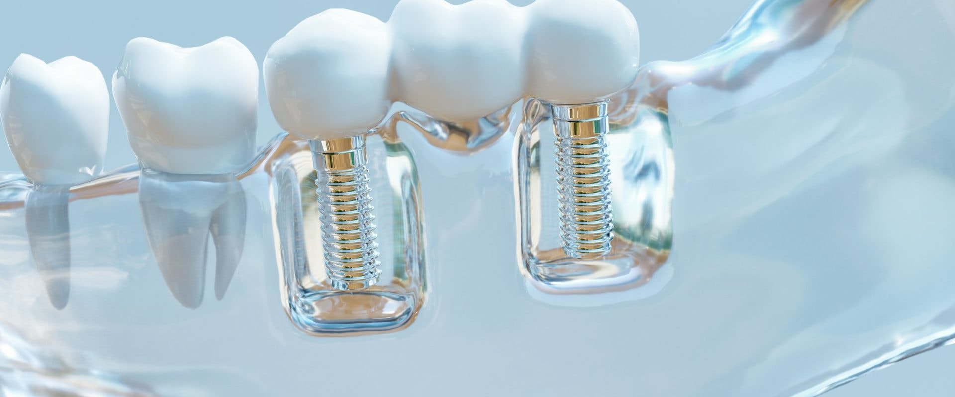 What are the most common causes of failure of dental implants?