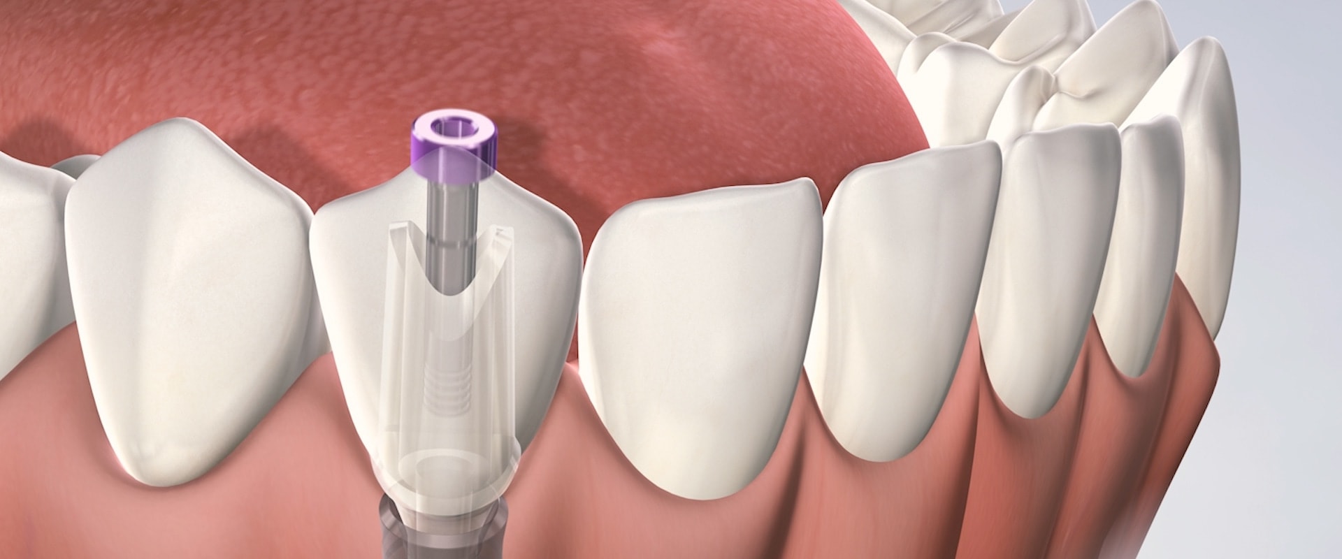 How long do dental implants hurt?