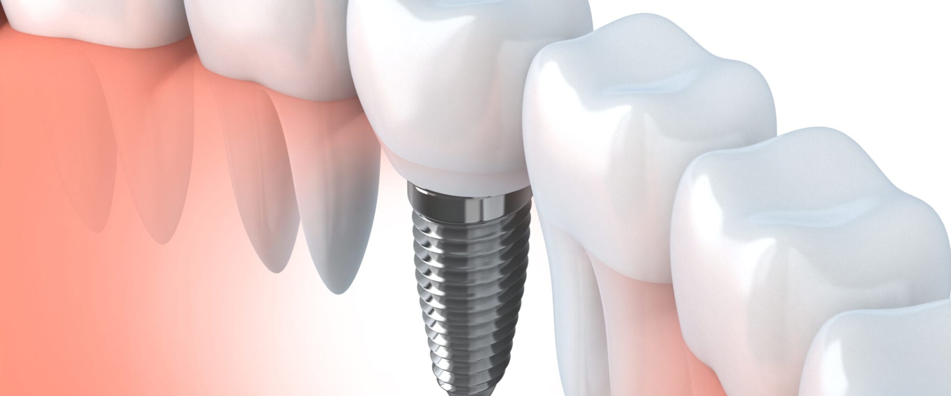 Exploring the Benefits of Dental Implants
