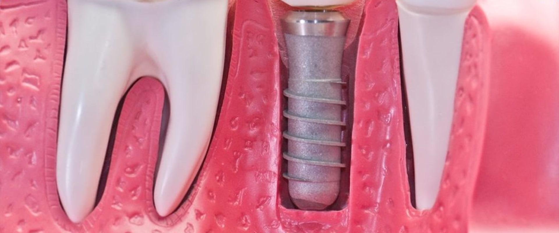 Which dental insurance covers implants?
