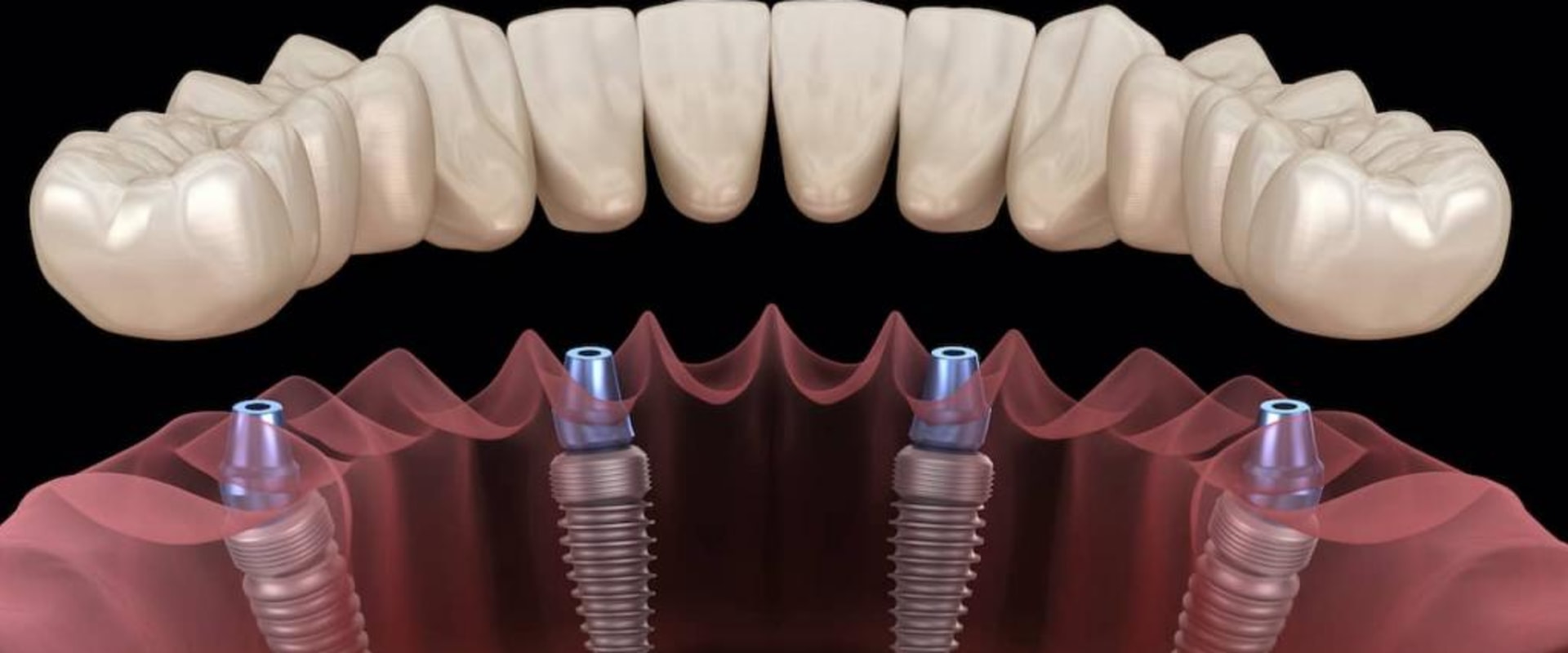 Which dental implants are the best?