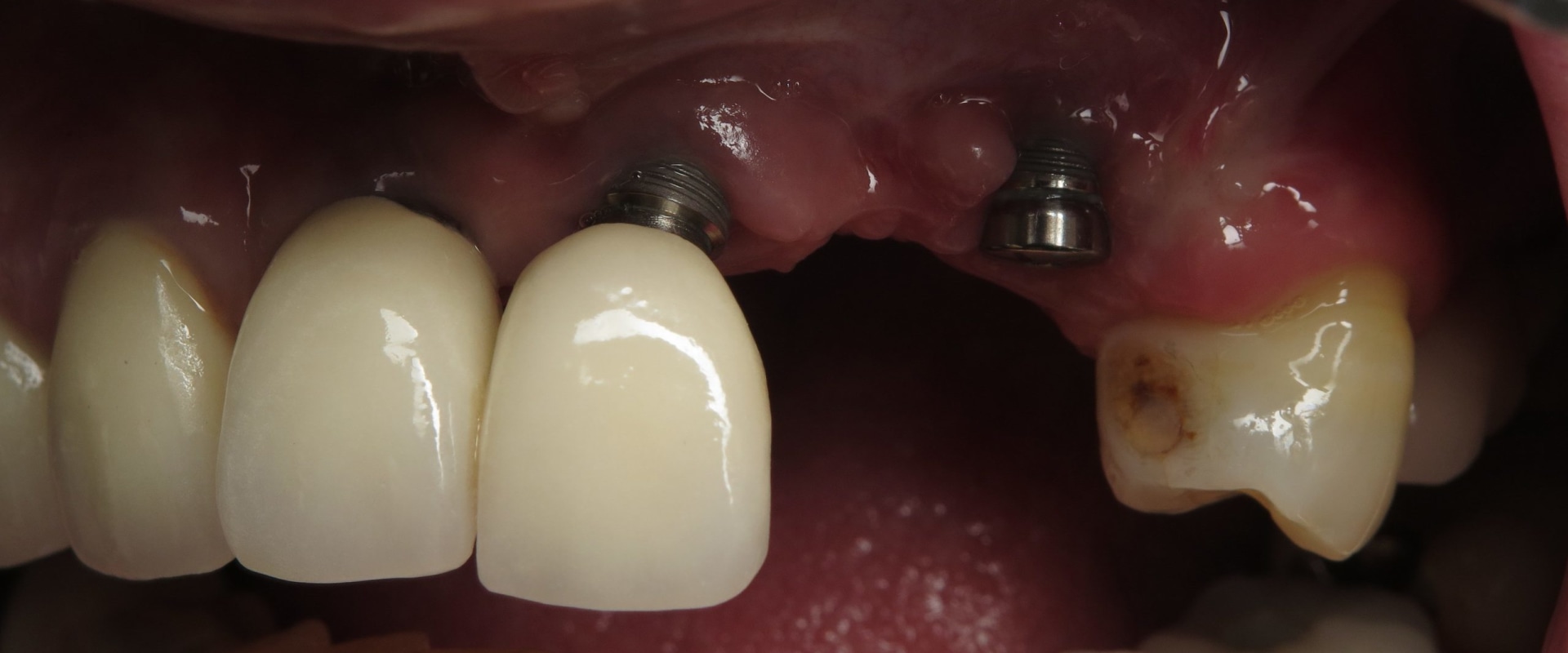 Can a failed dental implant be saved?