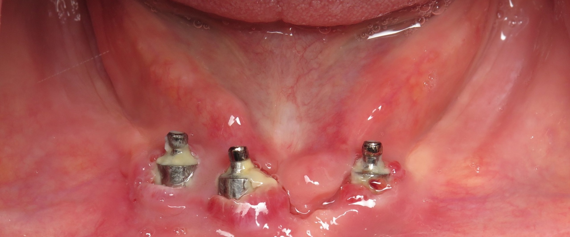 What does an infected dental implant feel like?