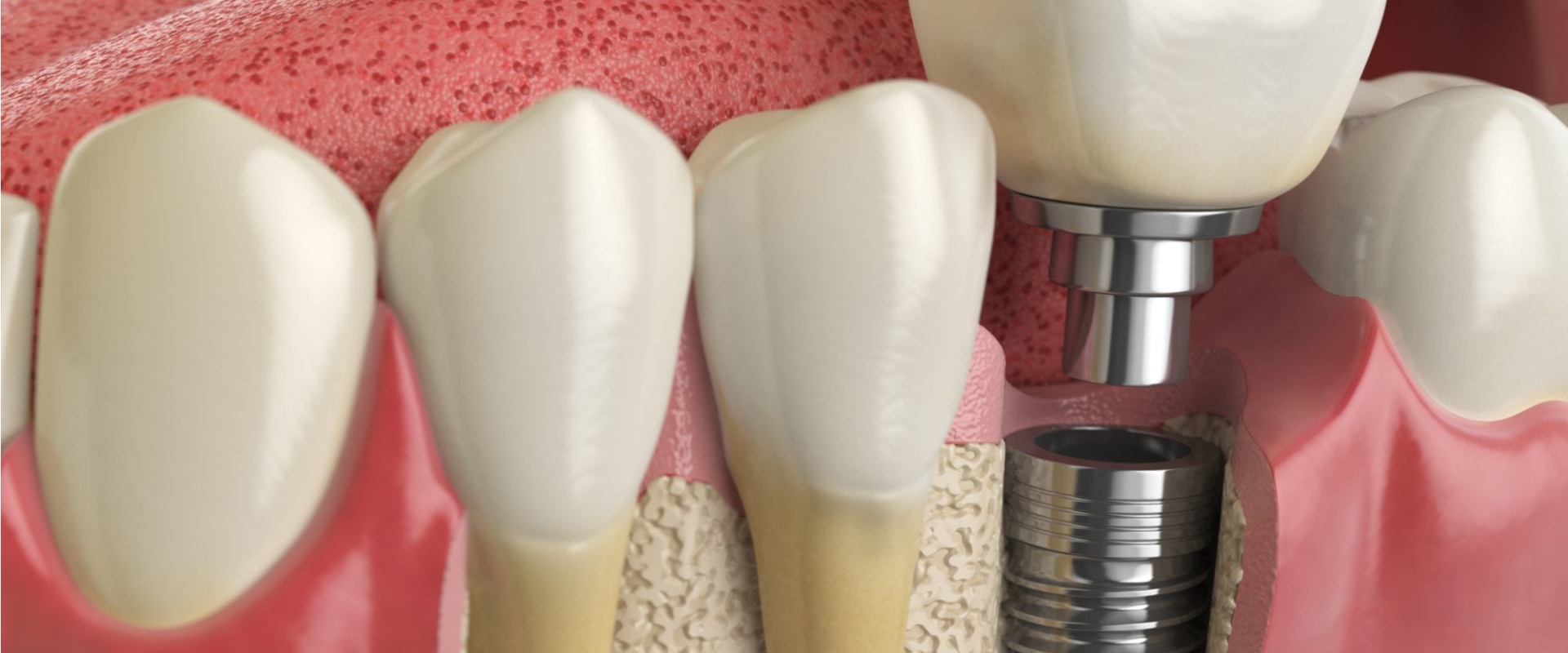 The Evolution of Dental Implants