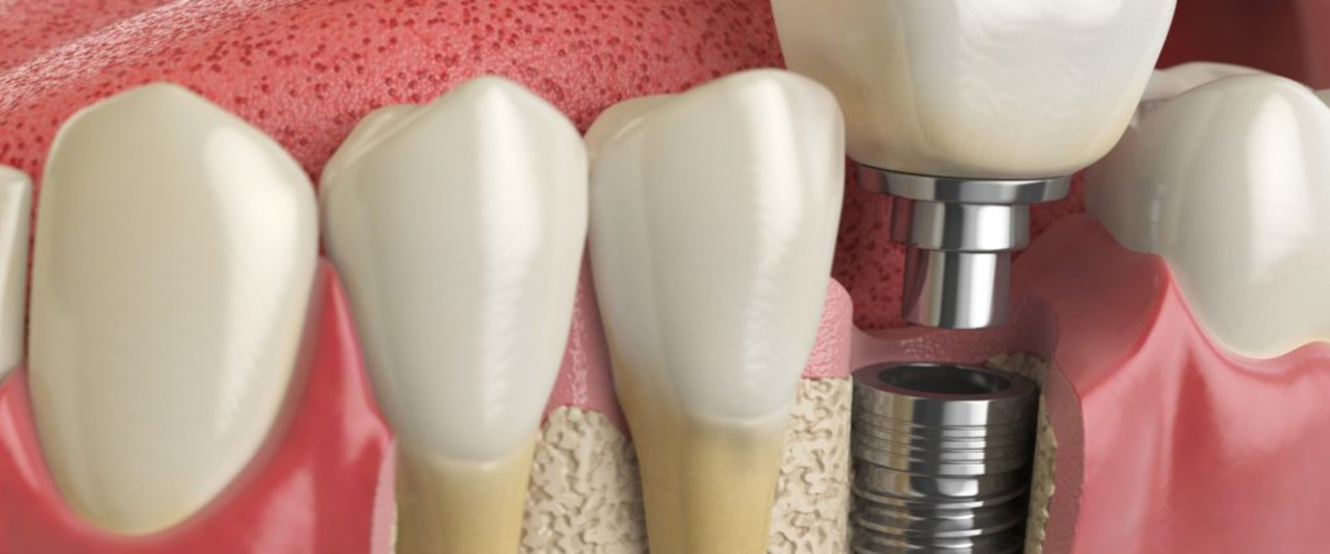 Why dental implants are not covered by insurance?