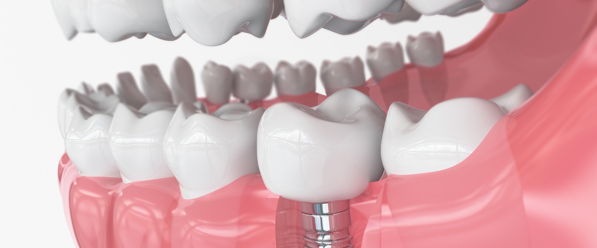 What are the 3 types of dental implants?