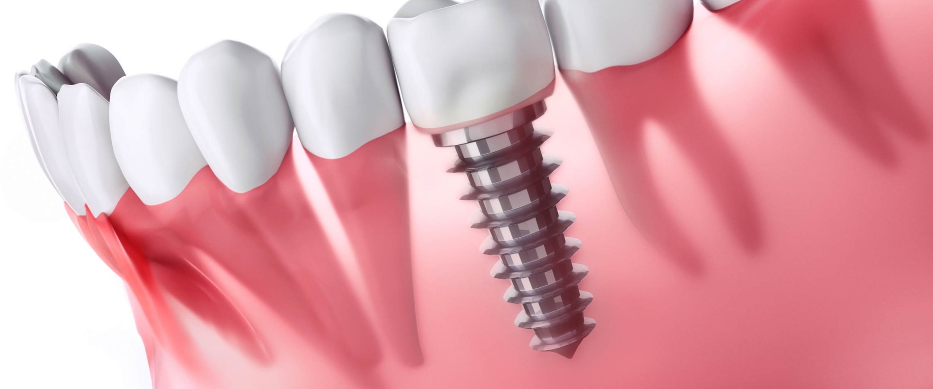 Where are dental implants done?