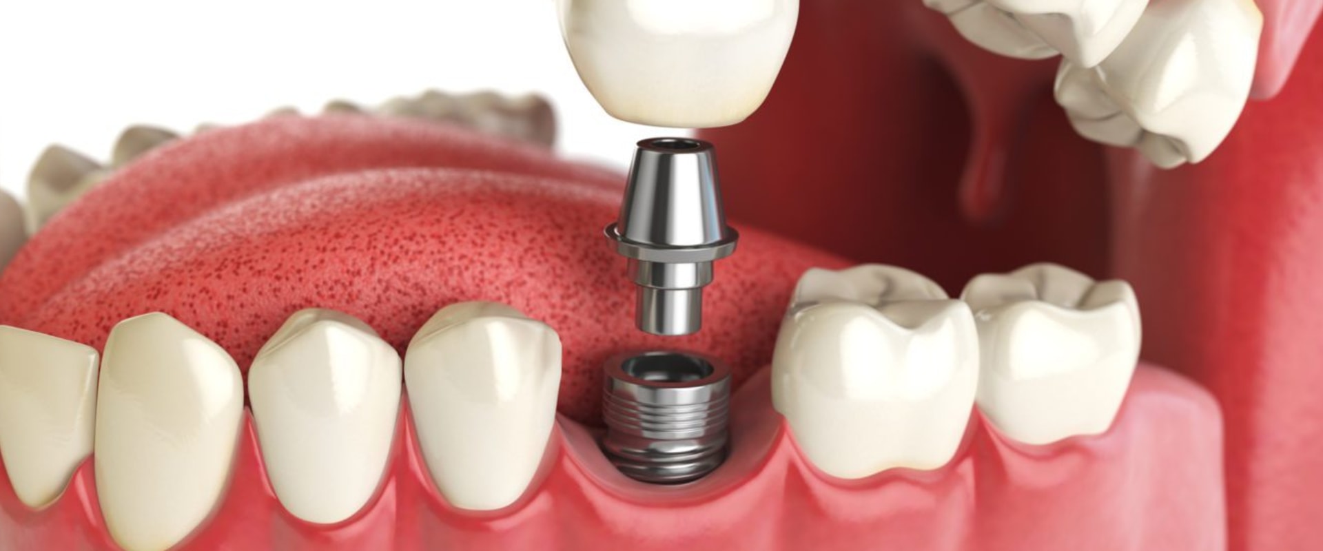 Can dental implants get cavities?