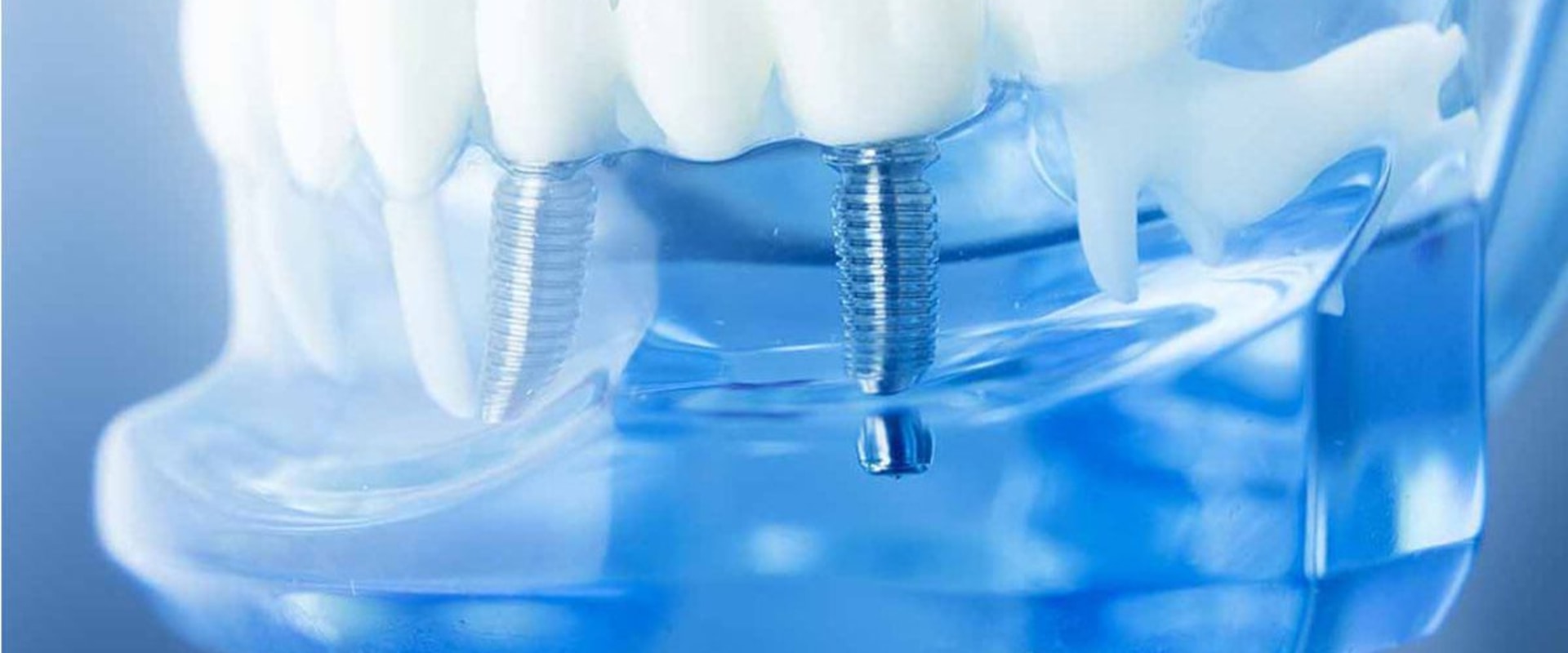 Who is not Suitable for Dental Implants