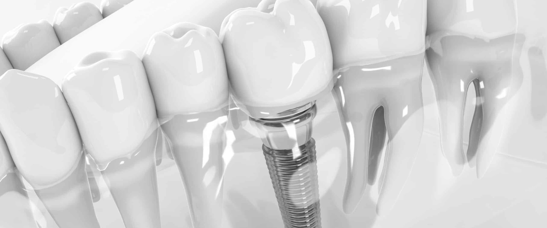 Transform Your Smile: The Advantages of Dental Implants