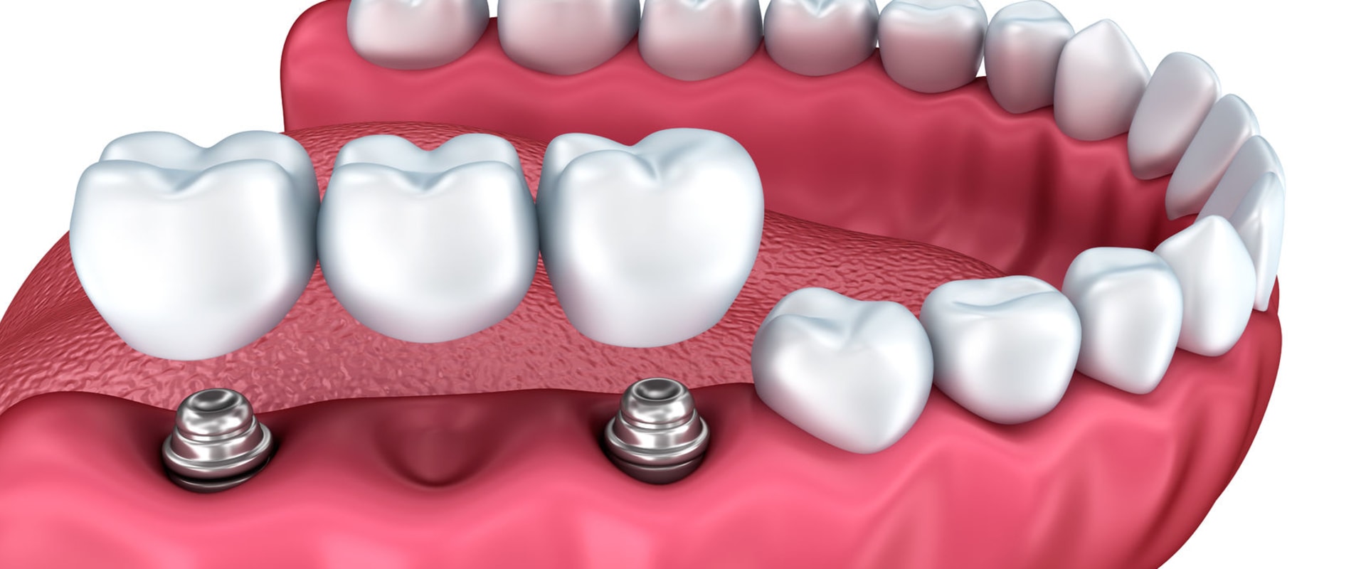 What are options instead of dental implants?