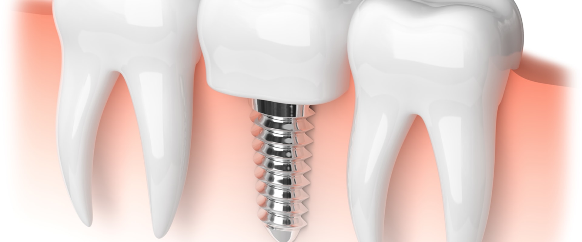 Who does dental implant work?