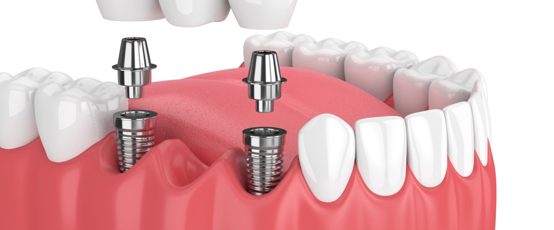 How long does pain last after dental implant?