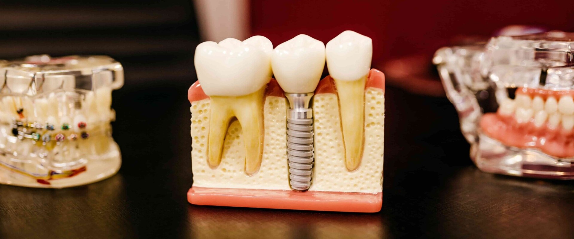 What Are the Side Effects of a Dental Implant