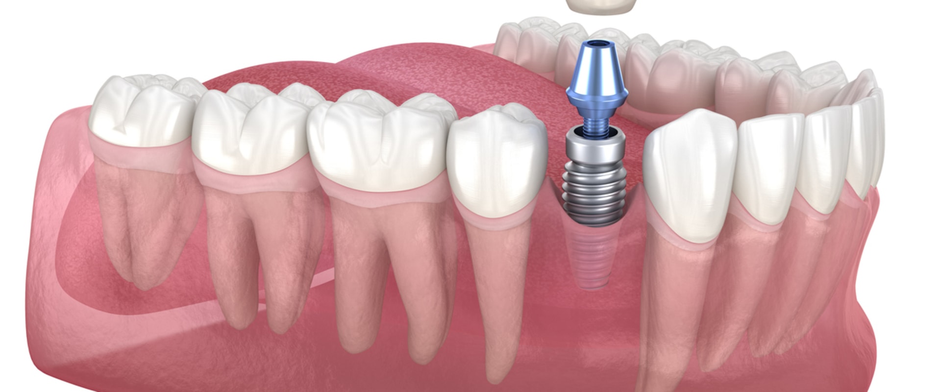 What are the downside of dental implants?