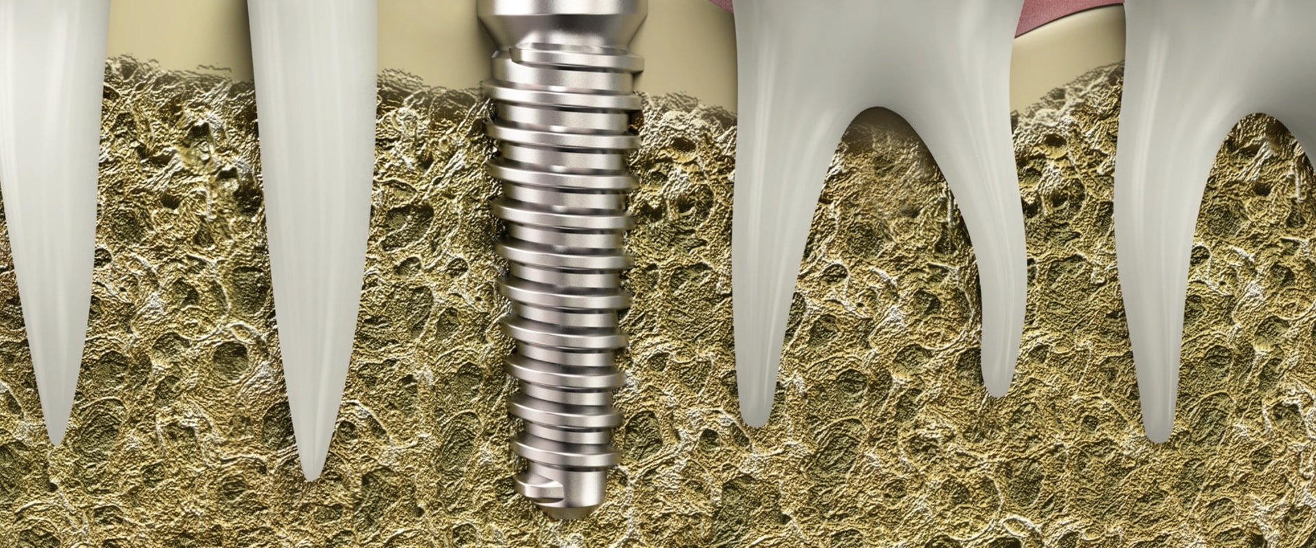 Why am i not suitable for dental implants?