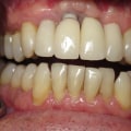 When dental implants don't work?