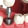 What dental implants cost?