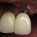 Can dental implant be redone?