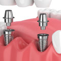 How dental implants are done?
