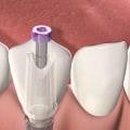 How long do dental implants hurt?