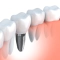 Exploring the Benefits of Dental Implants