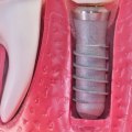 Which dental insurance covers implants?