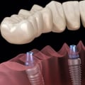Which dental implants are the best?