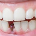 How quickly can dental implants be done?