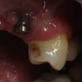 Can a failed tooth implant be replaced?