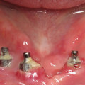 What does an infected dental implant feel like?