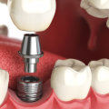 Are dental implants worth the risk?