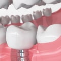 What are the 3 types of dental implants?