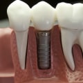Is a Dental Implant Permanent