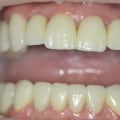 Are dental implants natural-looking?