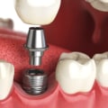 Can dental implants get cavities?