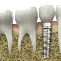 What makes you not a candidate for dental implants?