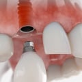Who implants teeth?
