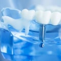Who is not Suitable for Dental Implants