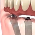 Who does dental implants?