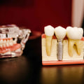 What are the Side Effects of a Tooth Implant