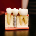 What Are the Side Effects of a Dental Implant