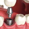 When are dental implants covered by insurance?