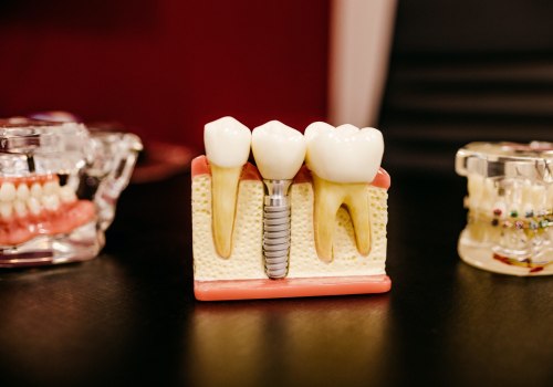 Dental Implants: A Lasting Solution for Missing Teeth