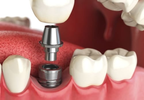 What dental implants cost?