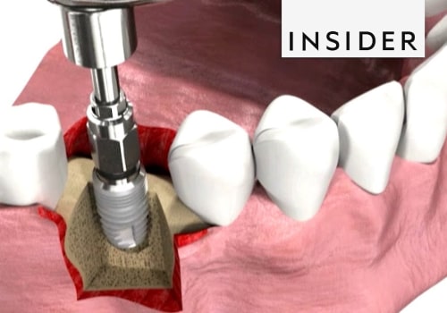 How dental implants are put in?